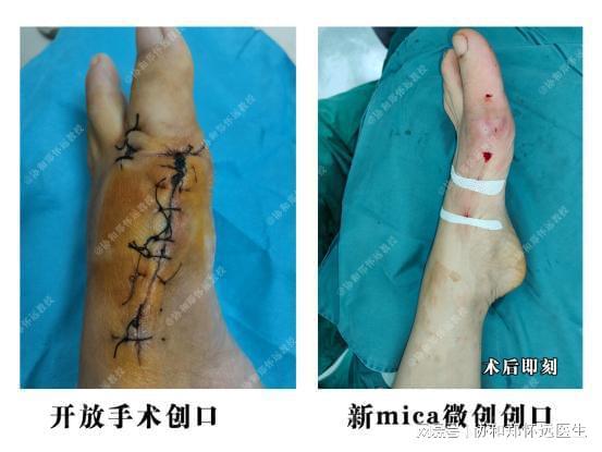 拇外翻手术过程视频,专业解析与康复指导