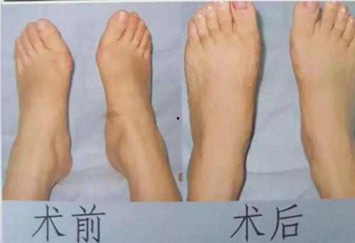 拇外翻手术过程视频,专业解析与康复指导