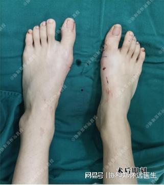拇外翻手术过程视频,专业解析与康复指导