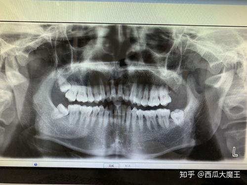 拔智齿视频全真实过程,拔智齿的真实手术过程