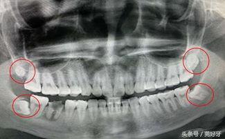 拔智齿视频全真实过程,拔智齿的真实手术过程