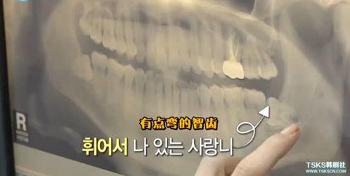 拔智齿视频全真实过程,拔智齿的真实手术过程