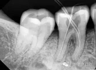 根管治疗全过程视频,从诊断到恢复的全方位解析