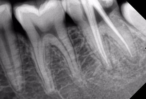 根管治疗全过程视频,从诊断到恢复的全方位解析