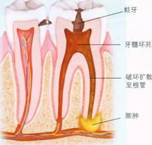 根管治疗全过程视频,从诊断到恢复的全方位解析
