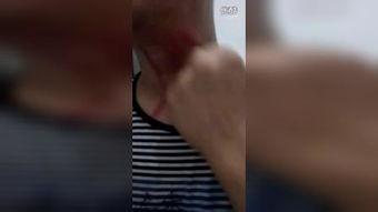 扯痧视频,传统养生新体验